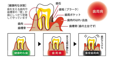 歯周病について