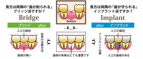 インプラントの大きなメリットは、「歯冠」と「歯根」の両方が回復できることです