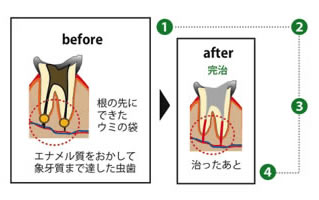 歯根の治療