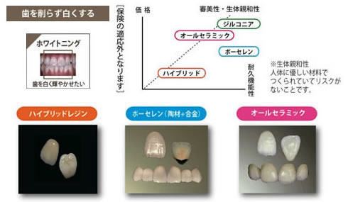 歯を削らずに白くする／歯冠修復物を使って歯を白くする