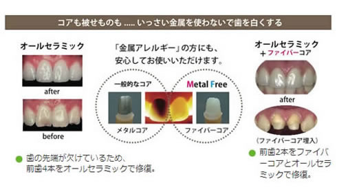 一切金属を使わずに歯を白くする