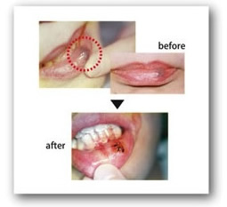 口唇血管腫除去の症例