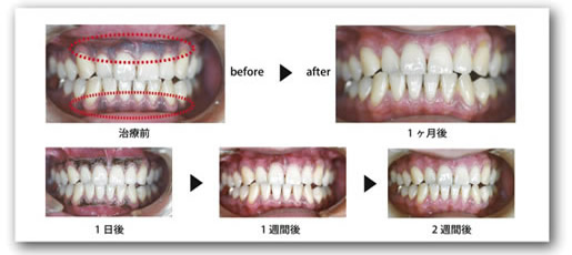 治療は痛みもなく、1～2週間で良好な歯肉が得られていきます。