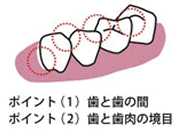 プロのケア（PMTC）