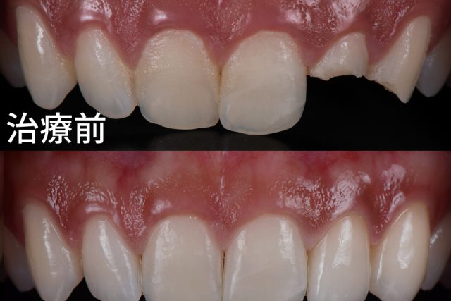 治療例／セラミック製の歯の冠で折れた前歯を固定する治療