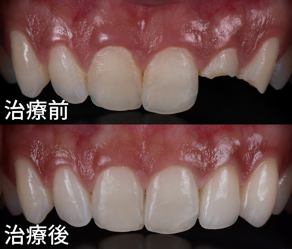 セラミック製の歯の冠で折れた前歯を固定する治療